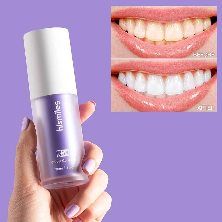 teeth whitening 